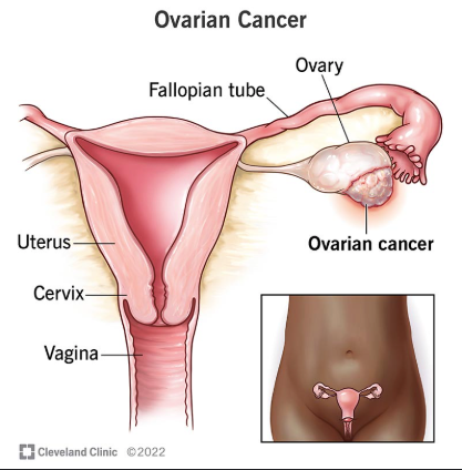 ovariancancer